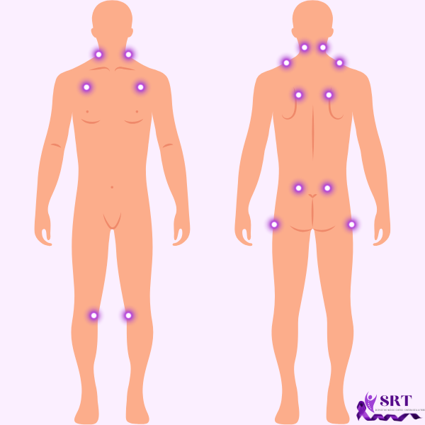 Fibromialgia